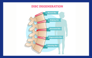 Back Pain Caused by Disc Degeneration