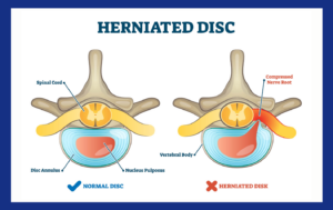 Back Pain Caused by a Herniated Disc
