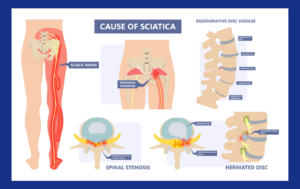 Back Pain Caused by Sciatica