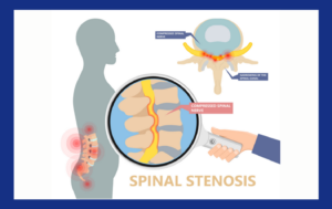 Back Pain Caused by Spinal Stenosis