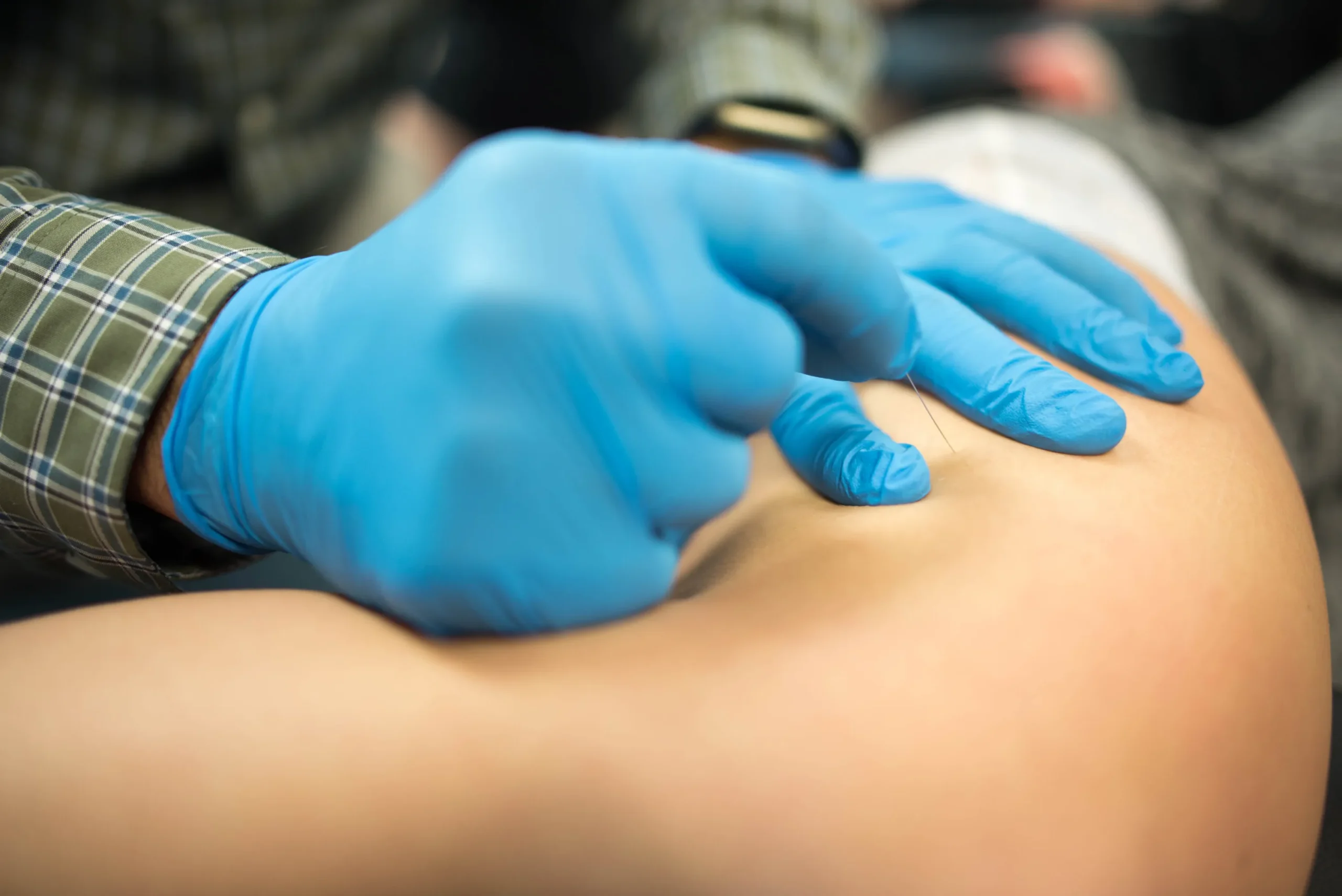 Dry needling in action.